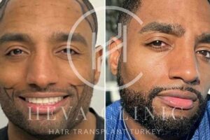 Unveiling the Secrets of African American Hair Implants: A Revolutionary Guide Africa Unveiled: Nature, Culture, and History Unveiling the Secrets of African American Hair Implants: A Revolutionary Guide | Africa Unveiled: Nature, Culture, and History