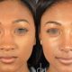 Discoveries and Insights: African American Rhinoplasty Before and After | Africa Unveiled: Nature, Culture, and History