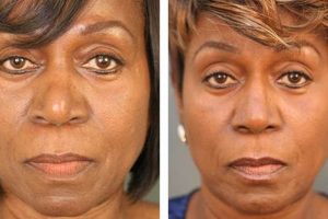 Unveiling the Secrets of Rhinoplasty for African Americans: Discoveries and Insights Africa Unveiled: Nature, Culture, and History Unveiling the Secrets of Rhinoplasty for African Americans: Discoveries and Insights | Africa Unveiled: Nature, Culture, and History