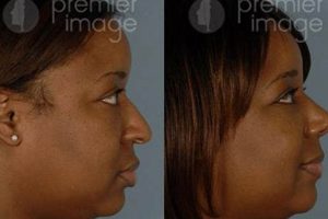 Unveiling the Secrets of African American Rhinoplasty in Atlanta: A Journey of Discovery Africa Unveiled: Nature, Culture, and History Unveiling the Secrets of African American Rhinoplasty in Atlanta: A Journey of Discovery | Africa Unveiled: Nature, Culture, and History
