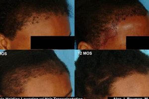 Unveil the Secrets of Hair Transplants for African American Women: Discoveries and Insights Africa Unveiled: Nature, Culture, and History Unveil the Secrets of Hair Transplants for African American Women: Discoveries and Insights | Africa Unveiled: Nature, Culture, and History