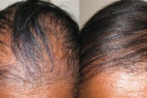 Unveiling the Secrets of Hair Transplants for African Americans: Discoveries and Insights Africa Unveiled: Nature, Culture, and History Unveiling the Secrets of Hair Transplants for African Americans: Discoveries and Insights | Africa Unveiled: Nature, Culture, and History