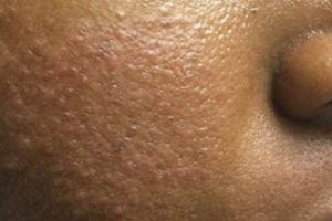 Unlocking the Mysteries of Rosacea in African Americans Africa Unveiled: Nature, Culture, and History Unlocking the Mysteries of Rosacea in African Americans | Africa Unveiled: Nature, Culture, and History
