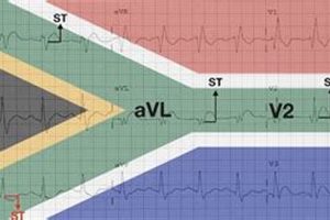Unlocking the Enigma of South African Flag Sign ECG: Unveiling New Discoveries Africa Unveiled: Nature, Culture, and History Unlocking the Enigma of South African Flag Sign ECG: Unveiling New Discoveries | Africa Unveiled: Nature, Culture, and History