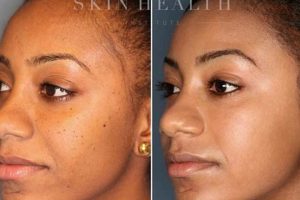 Unlock the Secrets of Laser Hair Removal for African American Skin in Atlanta Africa Unveiled: Nature, Culture, and History Unlock the Secrets of Laser Hair Removal for African American Skin in Atlanta | Africa Unveiled: Nature, Culture, and History