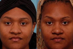 Unlock the Secrets of Rhinoplasty for African Americans: Discoveries and Insights Africa Unveiled: Nature, Culture, and History Unlock the Secrets of Rhinoplasty for African Americans: Discoveries and Insights | Africa Unveiled: Nature, Culture, and History